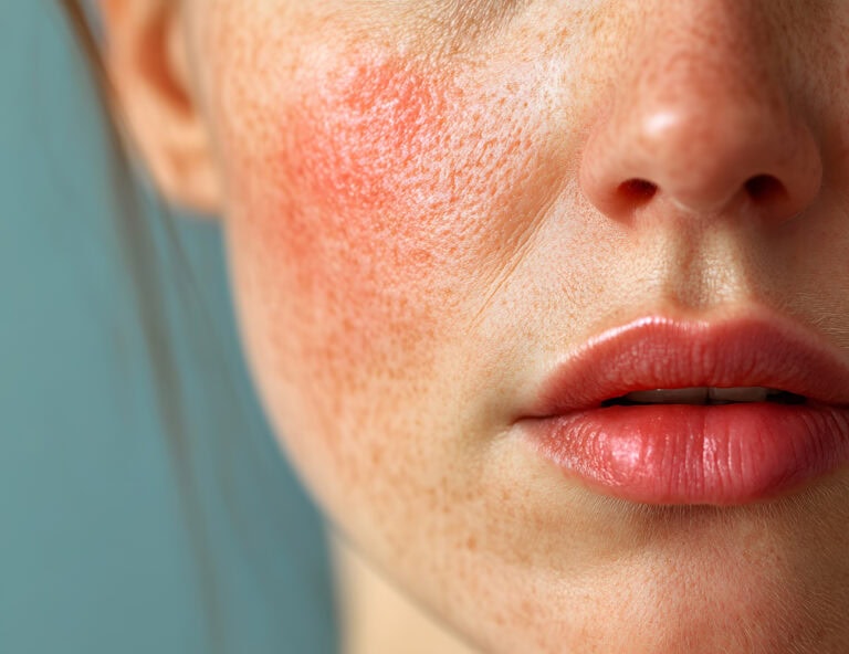 Roots Guard Rosacea